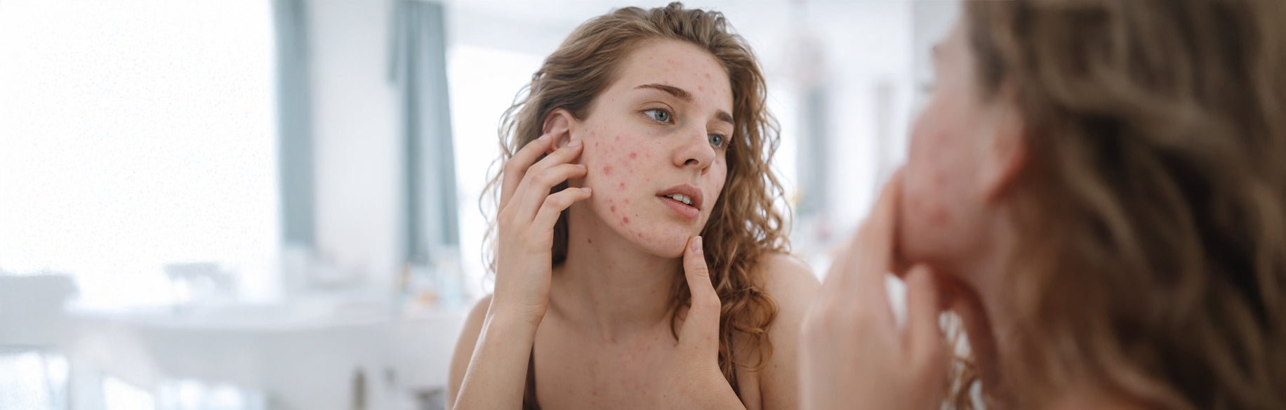 Acné en adultos: por qué aparece, síntomas, tipos y qué hacer